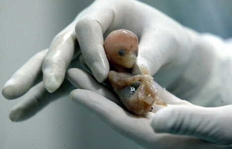 IVG avortement foetus interruption grossesse
